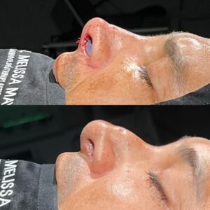 Dra Melissa Mayo. Rinoplastia Avanzada en Medellín