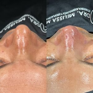 Dra Melissa Mayo. Rinoplastia Avanzada en Medellín