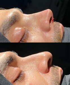Dra Melissa Mayo. Rinoplastia Avanzada en Medellín