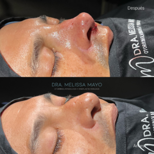 Dra Melissa Mayo. Rinoplastia Avanzada en Medellín