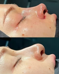 Dra Melissa Mayo. Rinoplastia Avanzada en Medellín