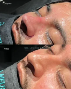 Dra Melissa Mayo. Rinoplastia Avanzada en Medellín