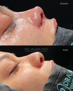 Dra Melissa Mayo. Rinoplastia Avanzada en Medellín