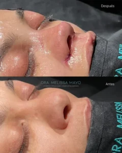 Dra Melissa Mayo. Rinoplastia Avanzada en Medellín