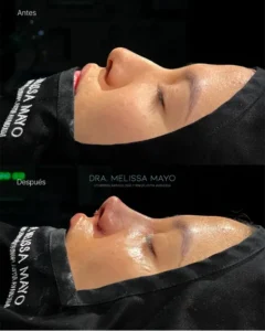 Dra Melissa Mayo. Rinoplastia Avanzada en Medellín