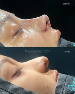 Dra Melissa Mayo. Rinoplastia Avanzada en Medellín