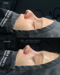 Dra Melissa Mayo. Rinoplastia Avanzada en Medellín