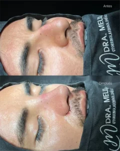 Dra Melissa Mayo. Rinoplastia Avanzada en Medellín