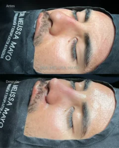 Dra Melissa Mayo. Rinoplastia Avanzada en Medellín