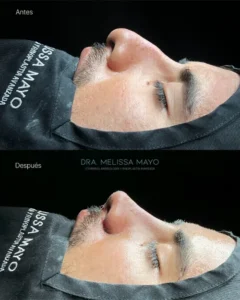 Dra Melissa Mayo. Rinoplastia Avanzada en Medellín