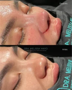 Dra Melissa Mayo. Rinoplastia Avanzada en Medellín