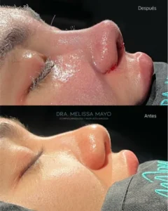 Dra Melissa Mayo. Rinoplastia Avanzada en Medellín