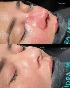 Dra Melissa Mayo. Rinoplastia Avanzada en Medellín