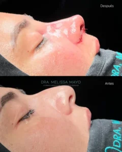 Dra Melissa Mayo. Rinoplastia Avanzada en Medellín