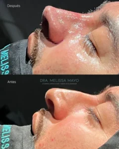Dra Melissa Mayo. Rinoplastia Avanzada en Medellín